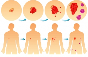 sarcoma skin cancer micronutrients