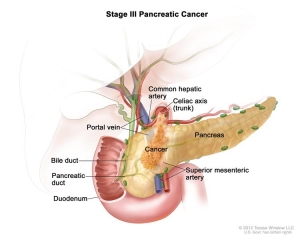 pancreatic cancer micronutrients