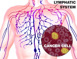 lymphoma micronutrients 