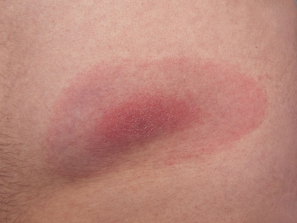 erythema lyme borrelia