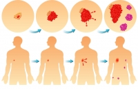 sarcoma skin cancer micronutrients