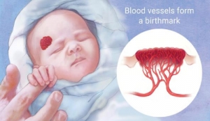 The Benefits Of Micronutrients In Hemangiomas