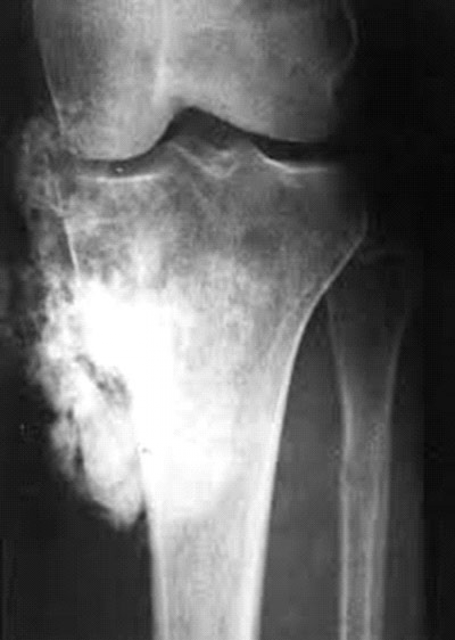 Диагноз саркома. Остеосаркома плечевой кости. Остеосаркома коленного сустава. Саркома коленного сустава рентген.
