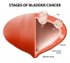 bladder cancer micronutrients 