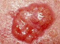 Information on the Natural Control of Skin Cancer