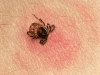 The Benefits of Micronutrients in Lyme Disease - Tick bite 