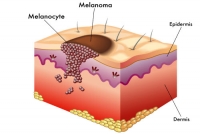 dr rath phytonutrients skin cancer melanoma vitamins