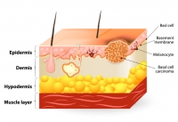 skin cancer melanoma micronutrients 