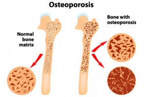 bones micronutrient dr rath osteoporosis