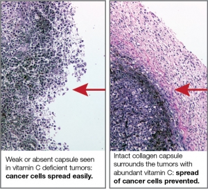 lung cancer micronutrients 