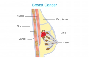 Vitamin D In Combination With Other Synergistic Micronutrients Can Benefit In Breast Cancer