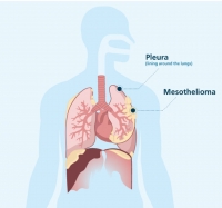 Micronutrients Can Benefit In Combatting Mesothelioma