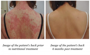 skin disease before after psoriasis study micronutrients