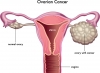 ovarian cancer micronutrients 