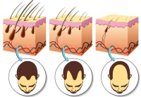 alopecia hair loss 