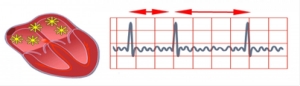 Nutrients Can Help Decrease Irregular Heartbeat (Arrhythmia)