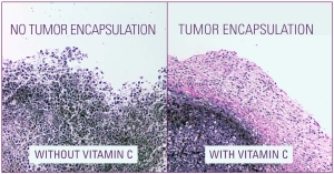 Research Supports Efficacy of Natural Approaches in Breast Cancer 